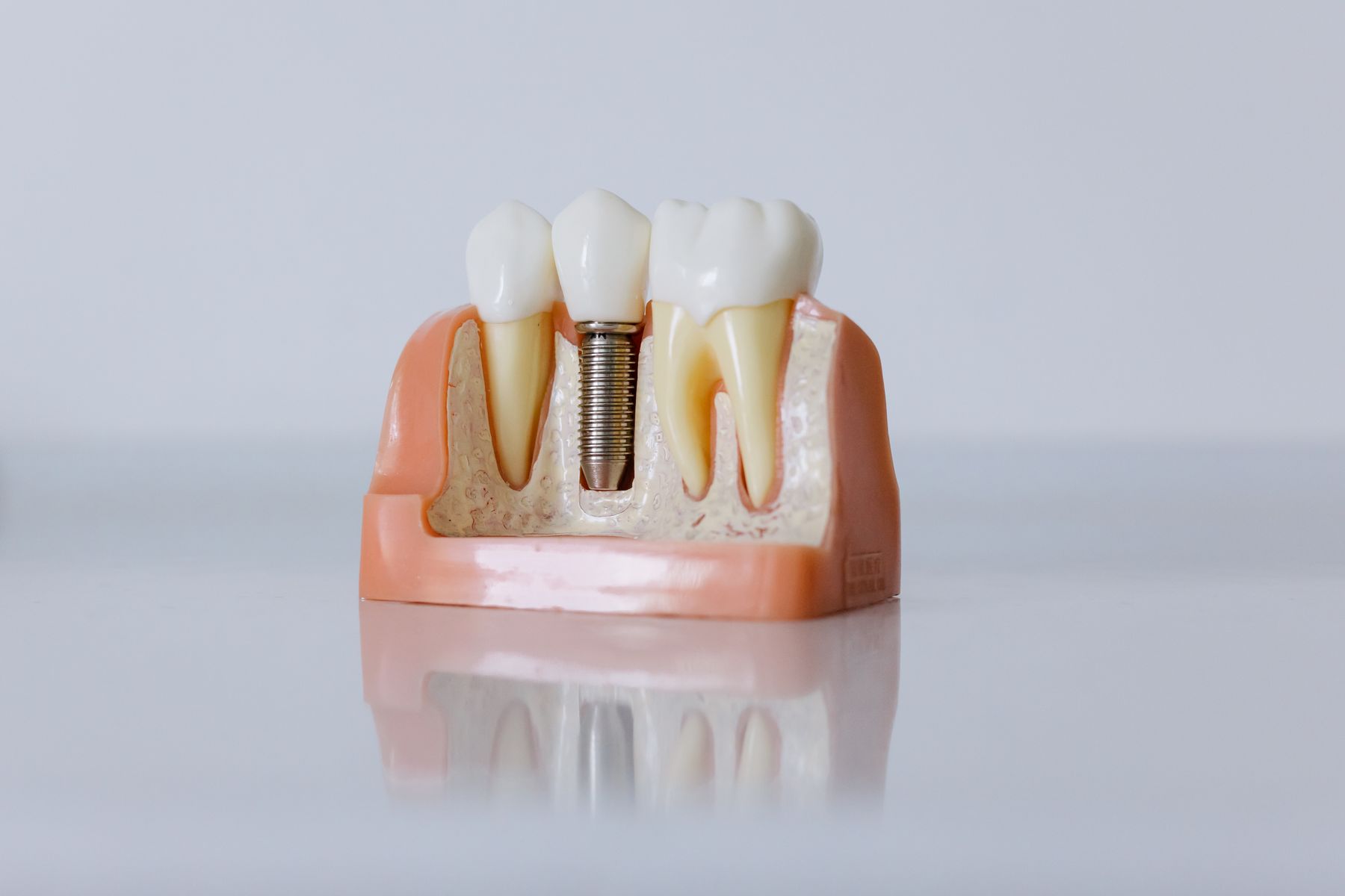 A dental implant model showing an artificial tooth root set in the jaw